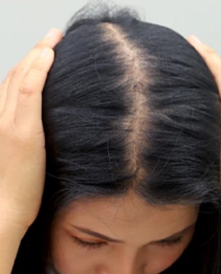Stress-Induced Hair Shedding and Hair Loss Treated with PRP Therapy in Pune