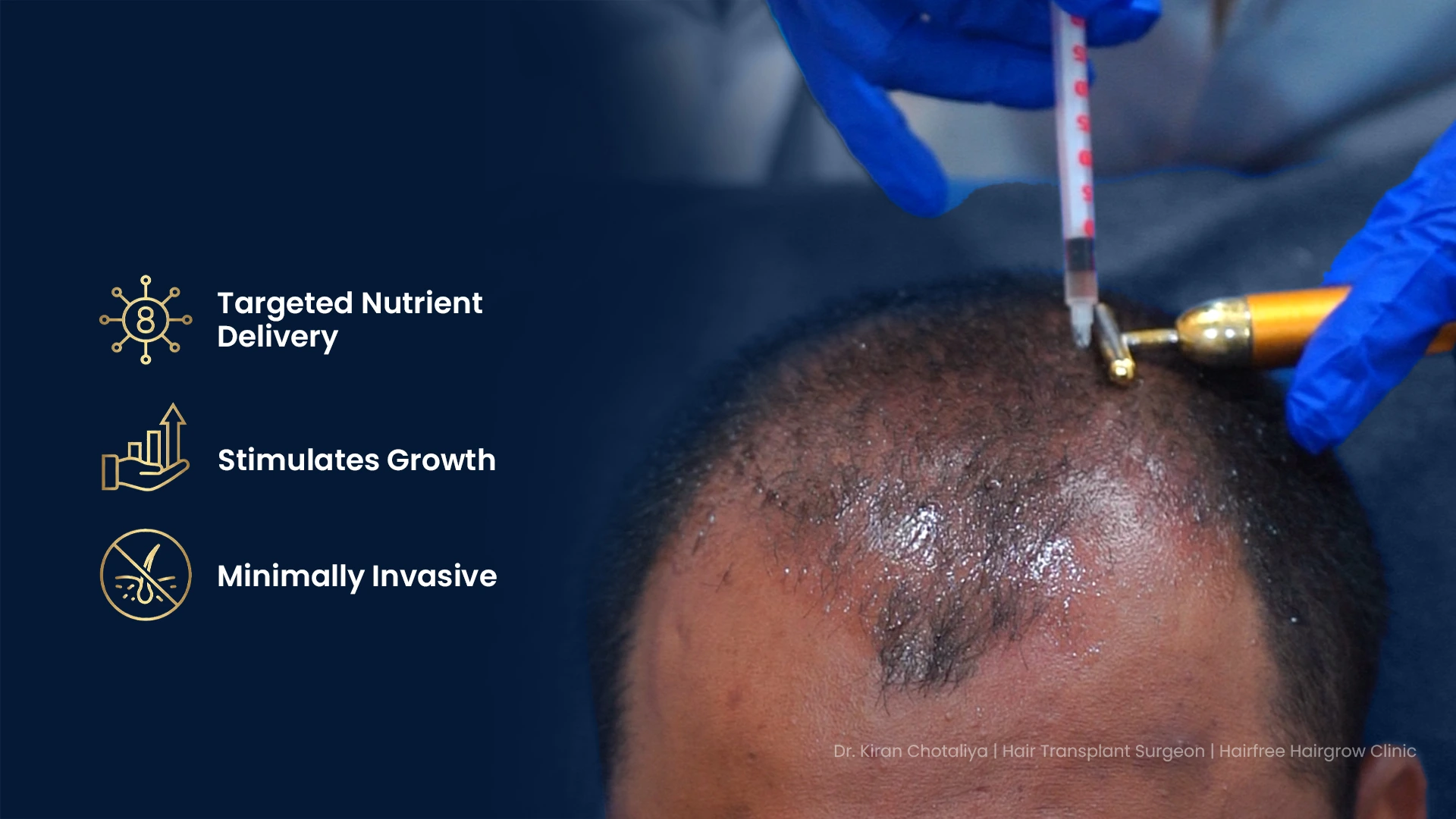 Mesotherapy for Hair Loss in Pune Showing Nutrient Injection Therapy for Hair Regrowth and Scalp Nourishment