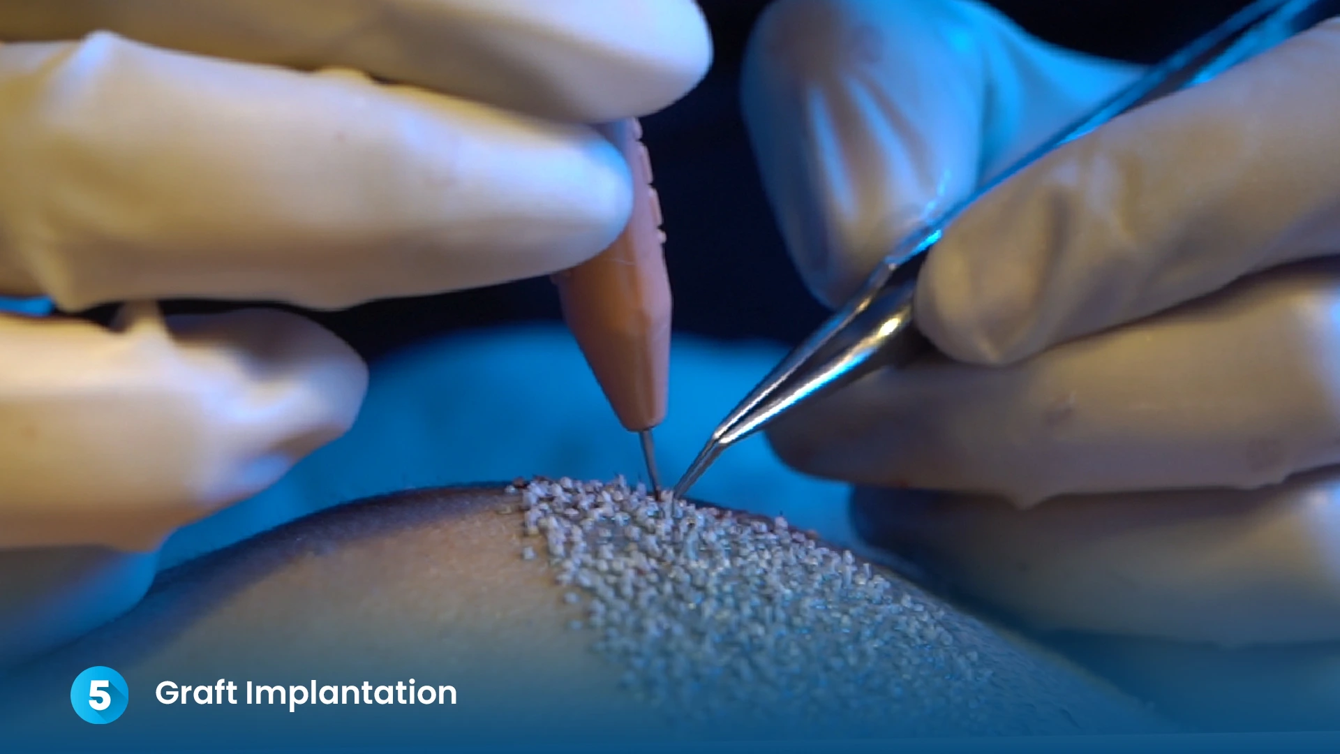 Step 5: Graft Implantation - Dr. Kiran Chotaliya Clinic