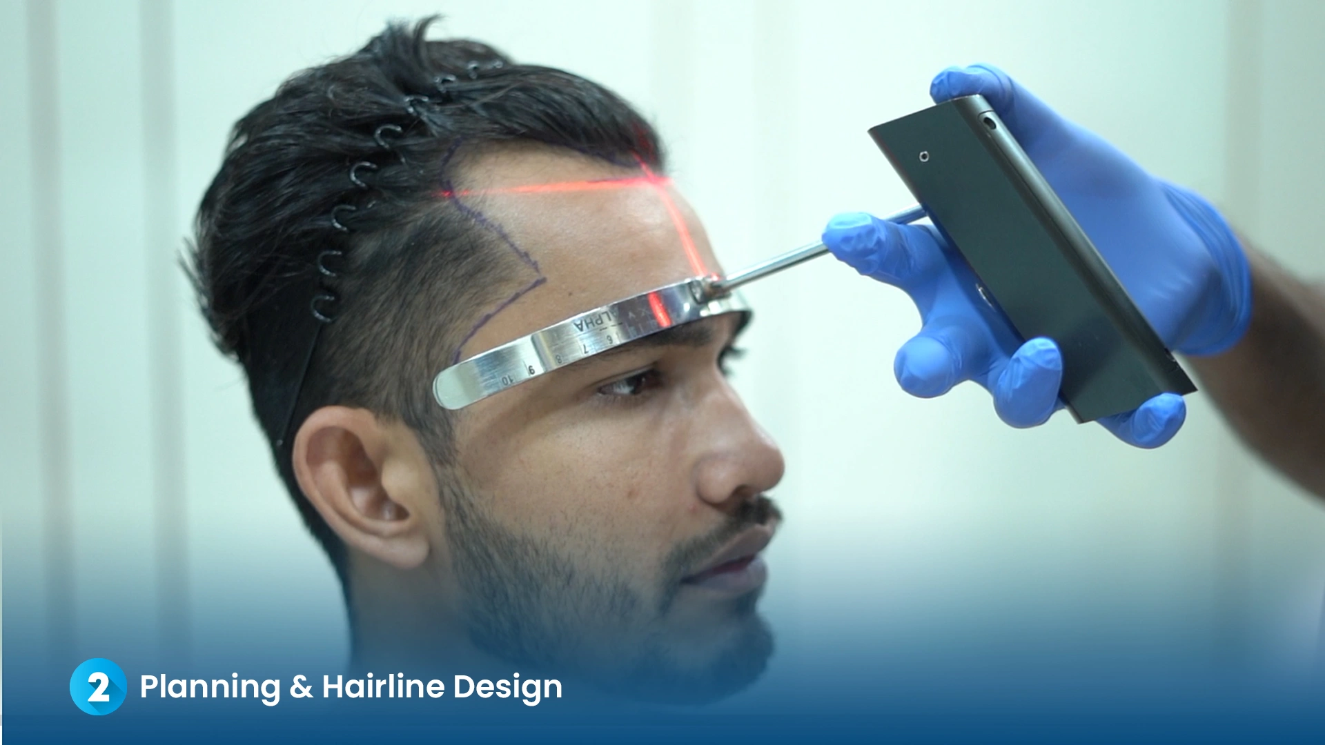 Step 2: Hairline Design and Planning - Dr. Kiran Chotaliya Clinic