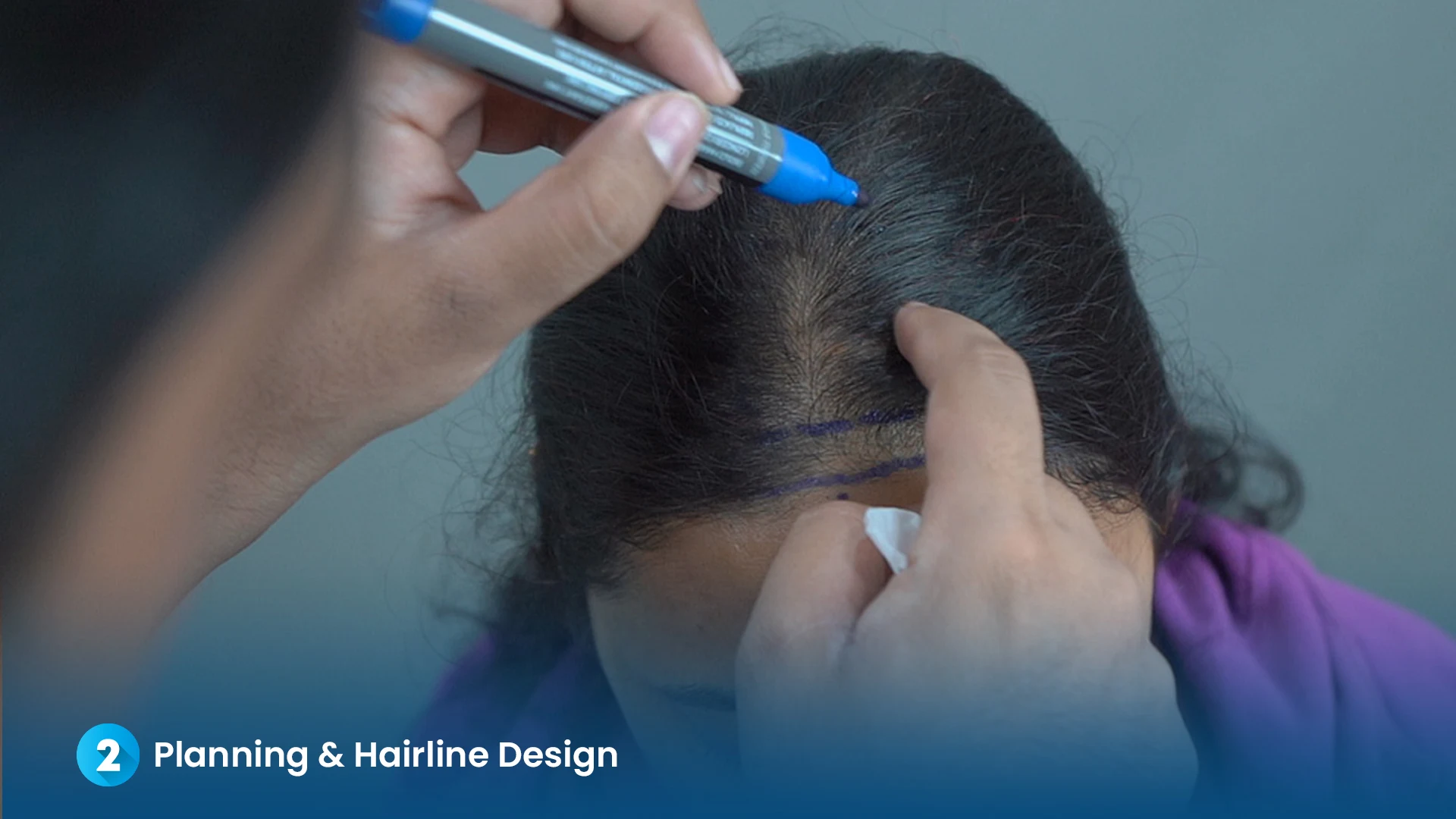 Step 2: Hairline Design and Planning - Dr. Kiran Chotaliya Clinic