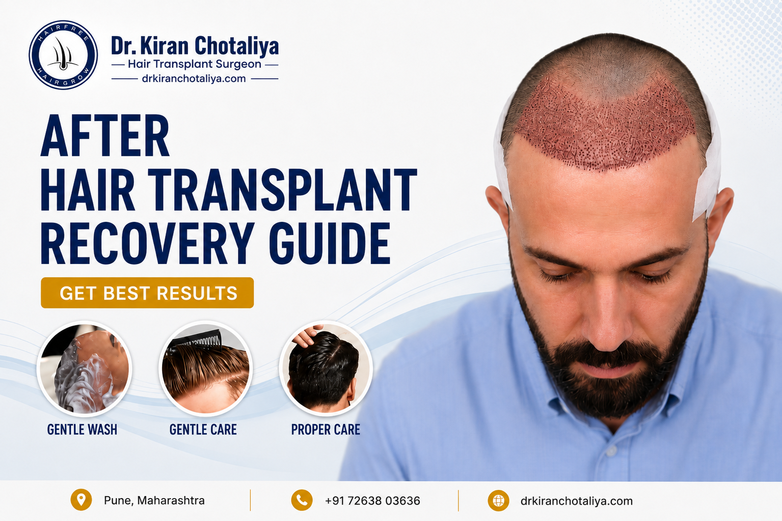 After Hair Transplant Recovery Guide