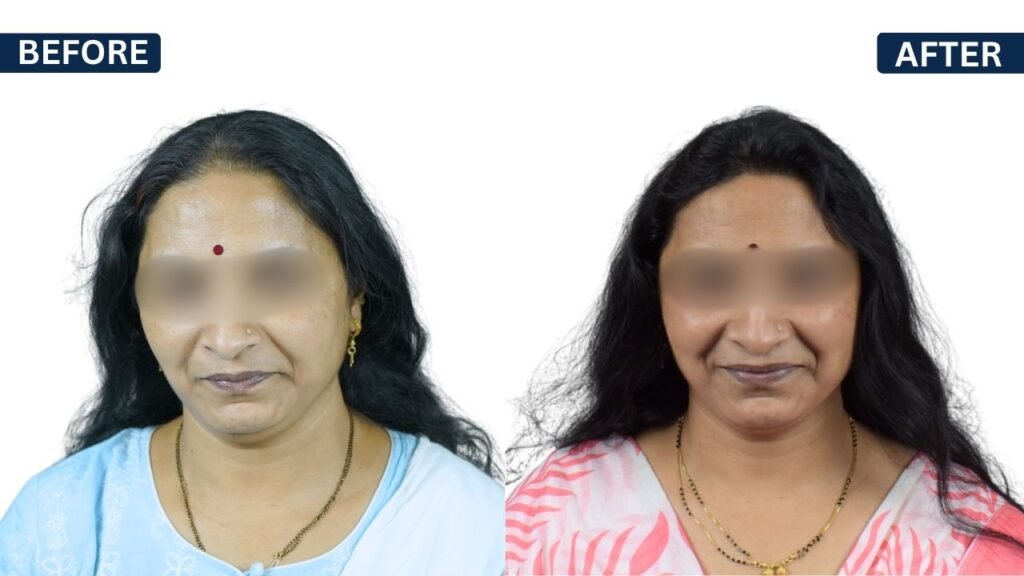 Anuradha Sutar hair transplant result