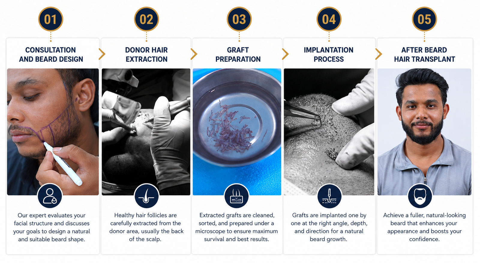 Beard Hair Transplant Procedure Step by Step FUE Beard Restoration.