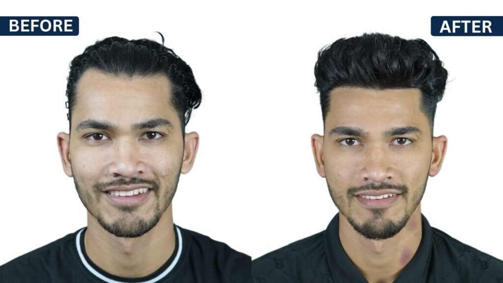 HIREN PARMAR Hair transplant | Hairfree and Hairgrow clinic pune | Dr. Kiran Chotaliya Hair transplant surgeon in Pune