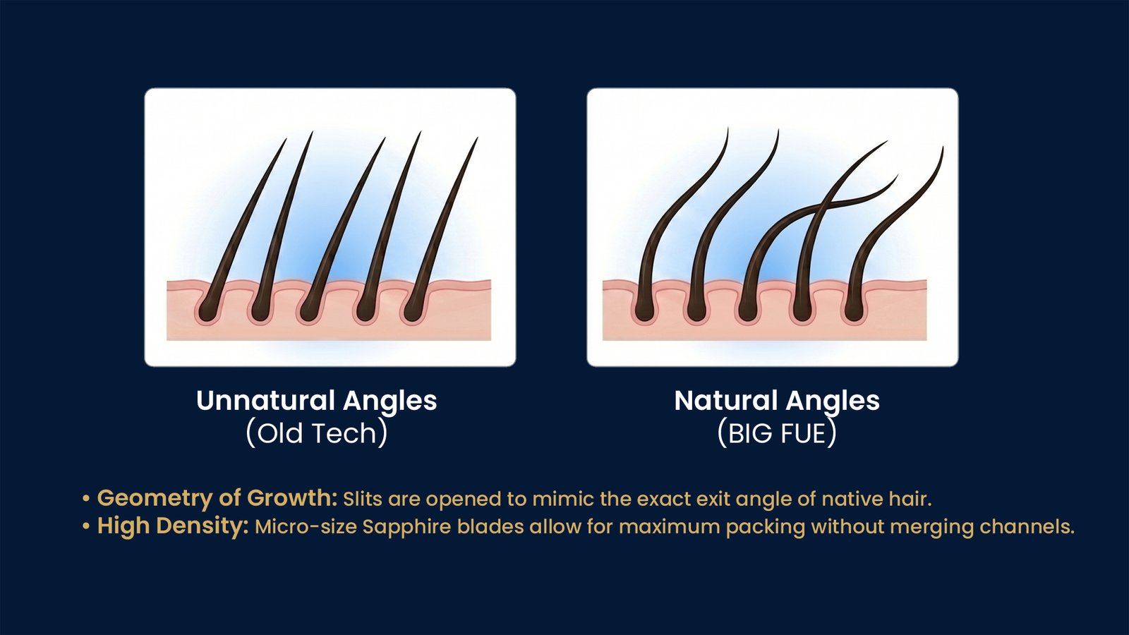 Natural hairline design in Pune showing correct hair angulation and follicle placement for natural-looking hair transplant results