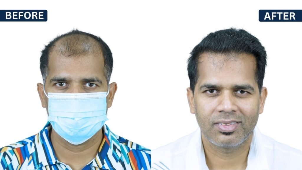 PAWAN SINGH Hair transplant | Hairfree and Hairgrow clinic pune | Dr. Kiran Chotaliya Hair transplant surgeon in Pune