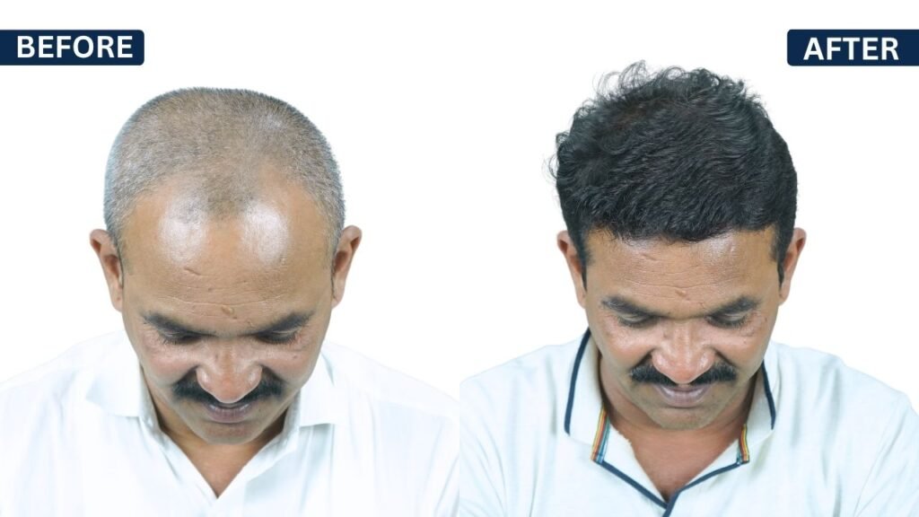 RAJENDRA DHAMALE Hair transplant | Hairfree and Hairgrow clinic pune | Dr. Kiran Chotaliya Hair transplant surgeon in Pune