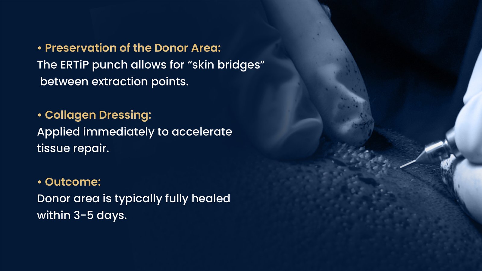 Strategic donor area extraction in Pune using advanced FUE technology to preserve donor density and promote faster healing