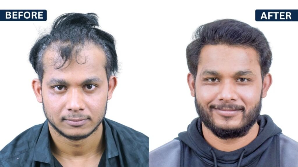 VINAY HIVRE Hair transplant | Hairfree and Hairgrow clinic pune | Dr. Kiran Chotaliya Hair transplant surgeon in Pune