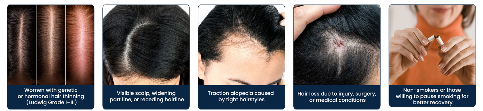 Who can opt for Female Hair Transplant Pune