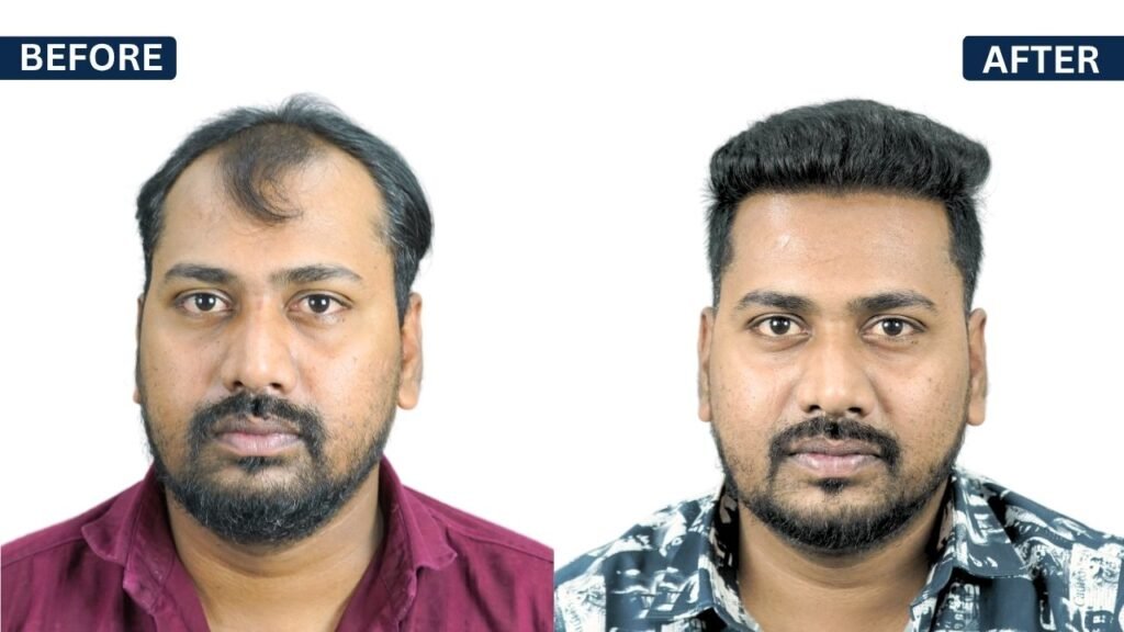 YUVRAJ SONAWANE Hair transplant | Hairfree and Hairgrow clinic pune | Dr. Kiran Chotaliya Hair transplant surgeon in Pune