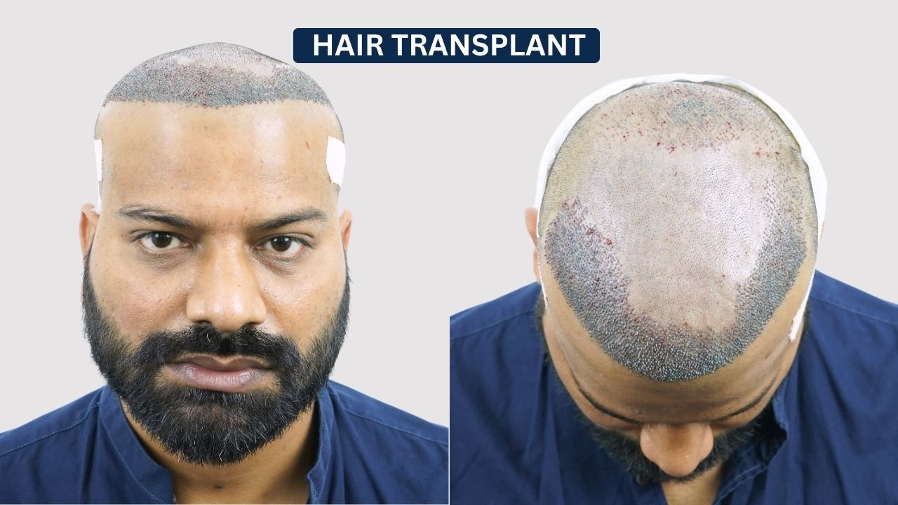 Hair Transplant in Pune Dr kiran chotaliya Hairfree and Hairgrow clinic