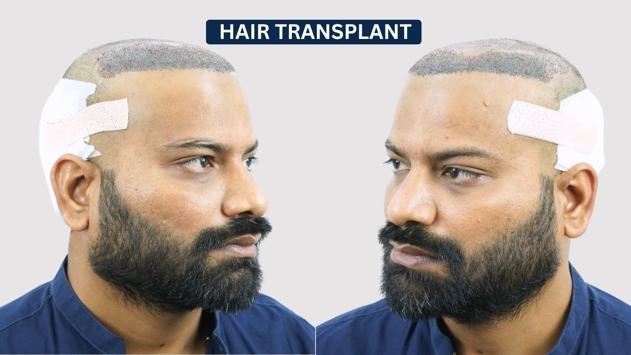 Hair Transplant in Pune Dr kiran chotaliya Hairfree and Hairgrow clinic