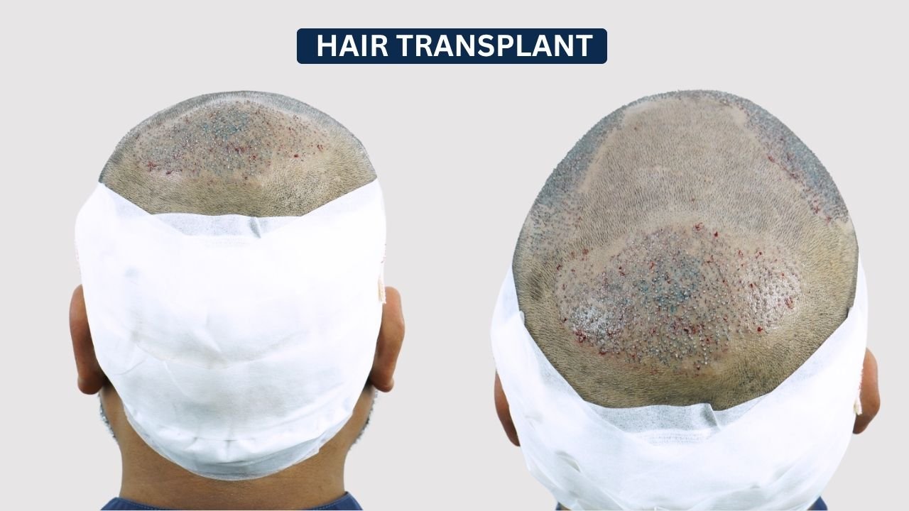 Hair Transplant in Pune Dr kiran chotaliya Hairfree and Hairgrow clinic