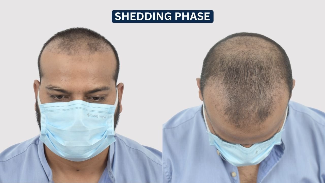 Hair Transplant in Pune Dr kiran chotaliya Hairfree and Hairgrow clinic
