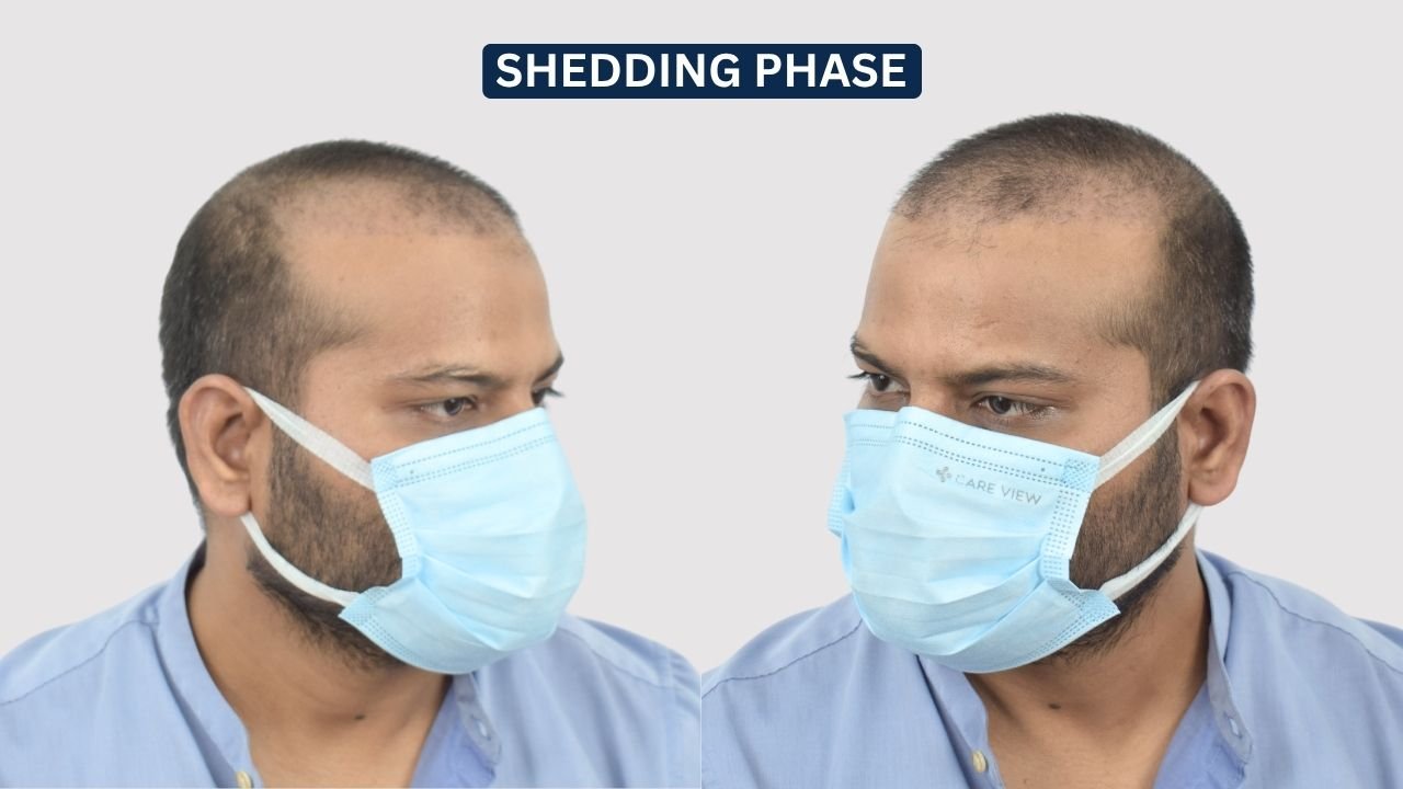 Hair Transplant in Pune Dr kiran chotaliya Hairfree and Hairgrow clinic