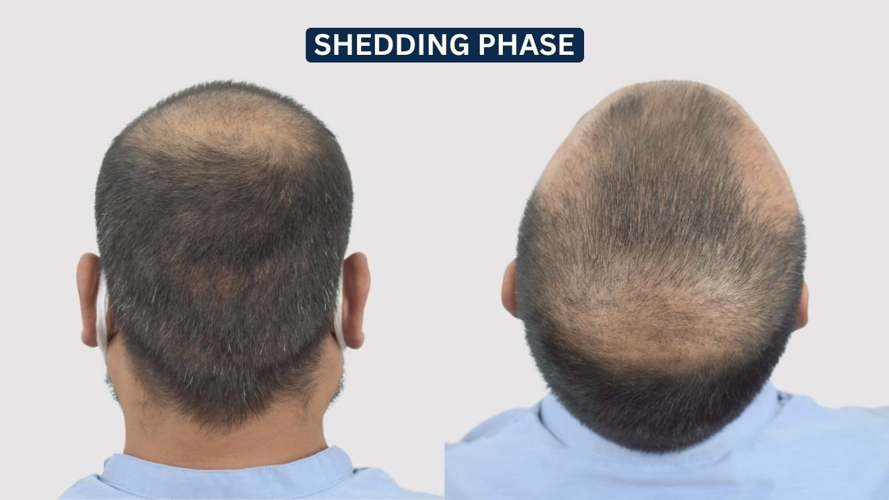 Hair Transplant in Pune Dr kiran chotaliya Hairfree and Hairgrow clinic