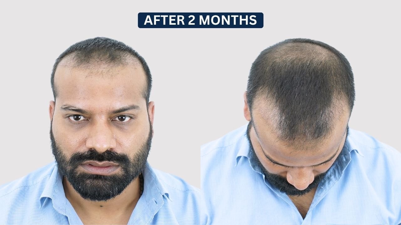 Hair Transplant in Pune Dr kiran chotaliya Hairfree and Hairgrow clinic