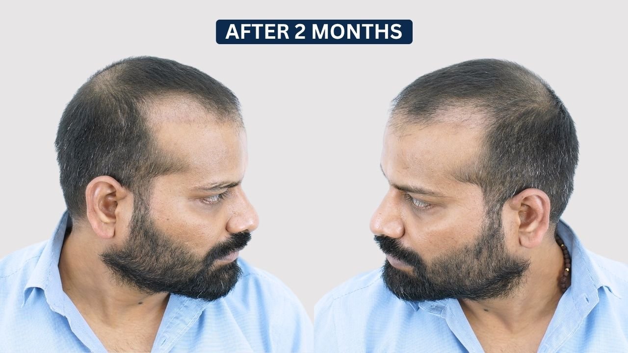 Hair Transplant in Pune Dr kiran chotaliya Hairfree and Hairgrow clinic