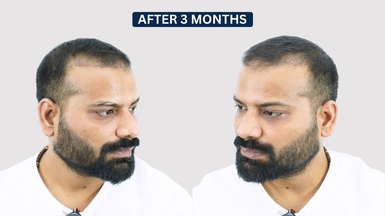 Hair Transplant in Pune Dr kiran chotaliya Hairfree and Hairgrow clinic