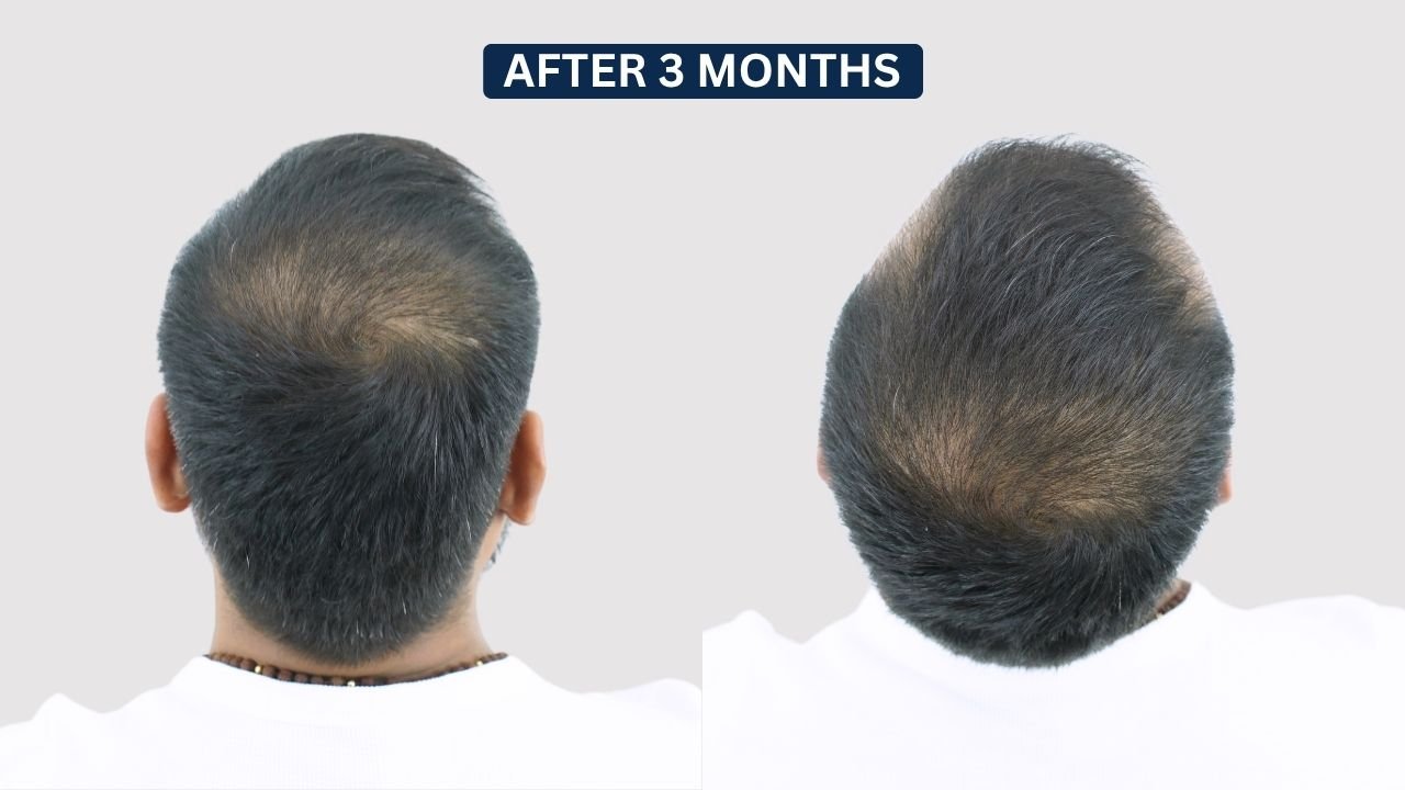 Hair Transplant in Pune Dr kiran chotaliya Hairfree and Hairgrow clinic