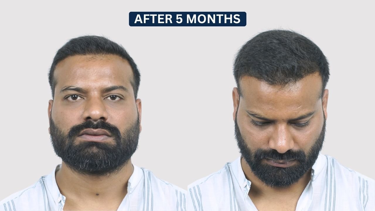 Hair Transplant in Pune Dr kiran chotaliya Hairfree and Hairgrow clinicHair Transplant in Pune Dr kiran chotaliya Hairfree and Hairgrow clinic