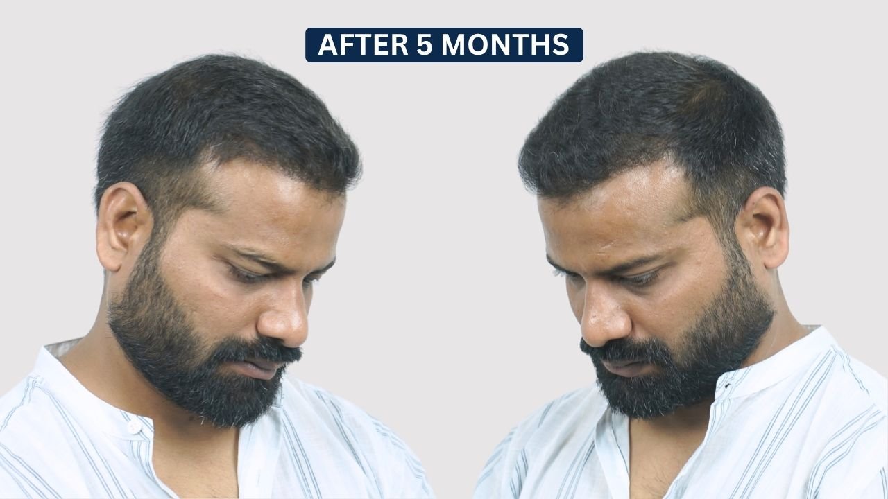 Hair Transplant in Pune Dr kiran chotaliya Hairfree and Hairgrow clinic