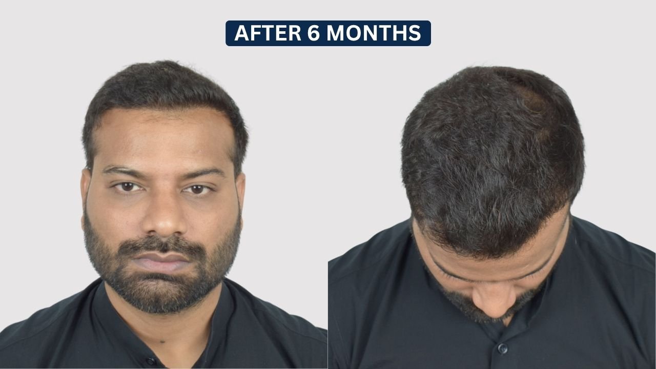 Hair Transplant in Pune Dr kiran chotaliya Hairfree and Hairgrow clinic