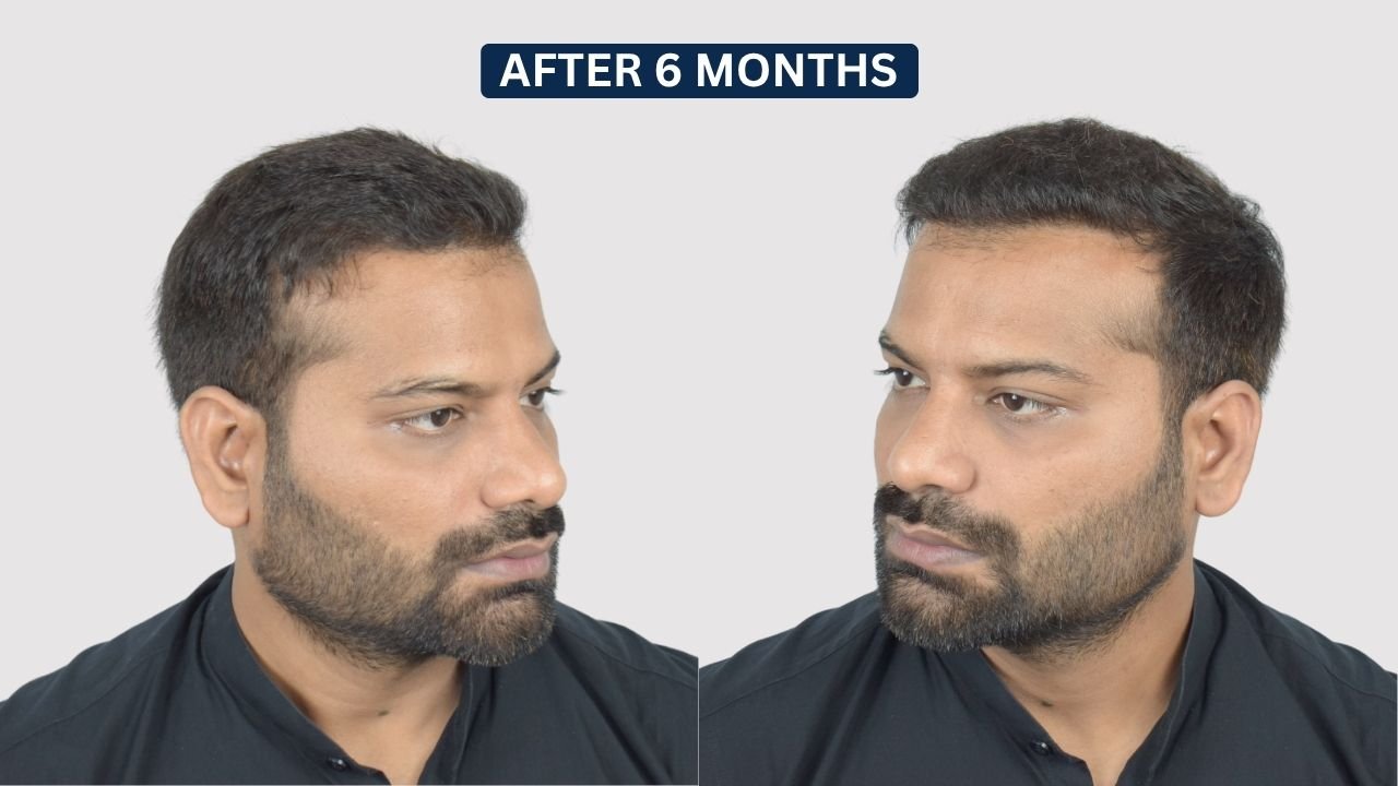Hair Transplant in Pune Dr kiran chotaliya Hairfree and Hairgrow clinic