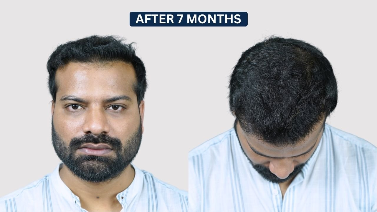 Hair Transplant in Pune Dr kiran chotaliya Hairfree and Hairgrow clinic