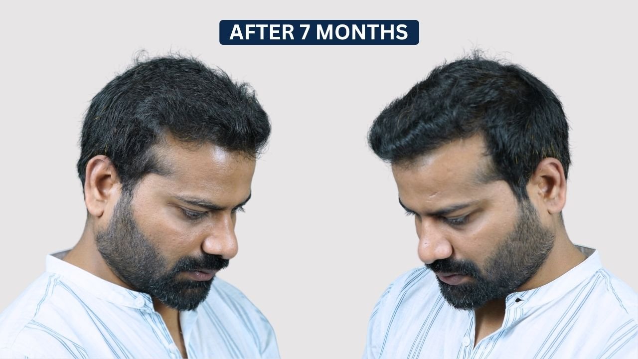 Hair Transplant in Pune Dr kiran chotaliya Hairfree and Hairgrow clinic