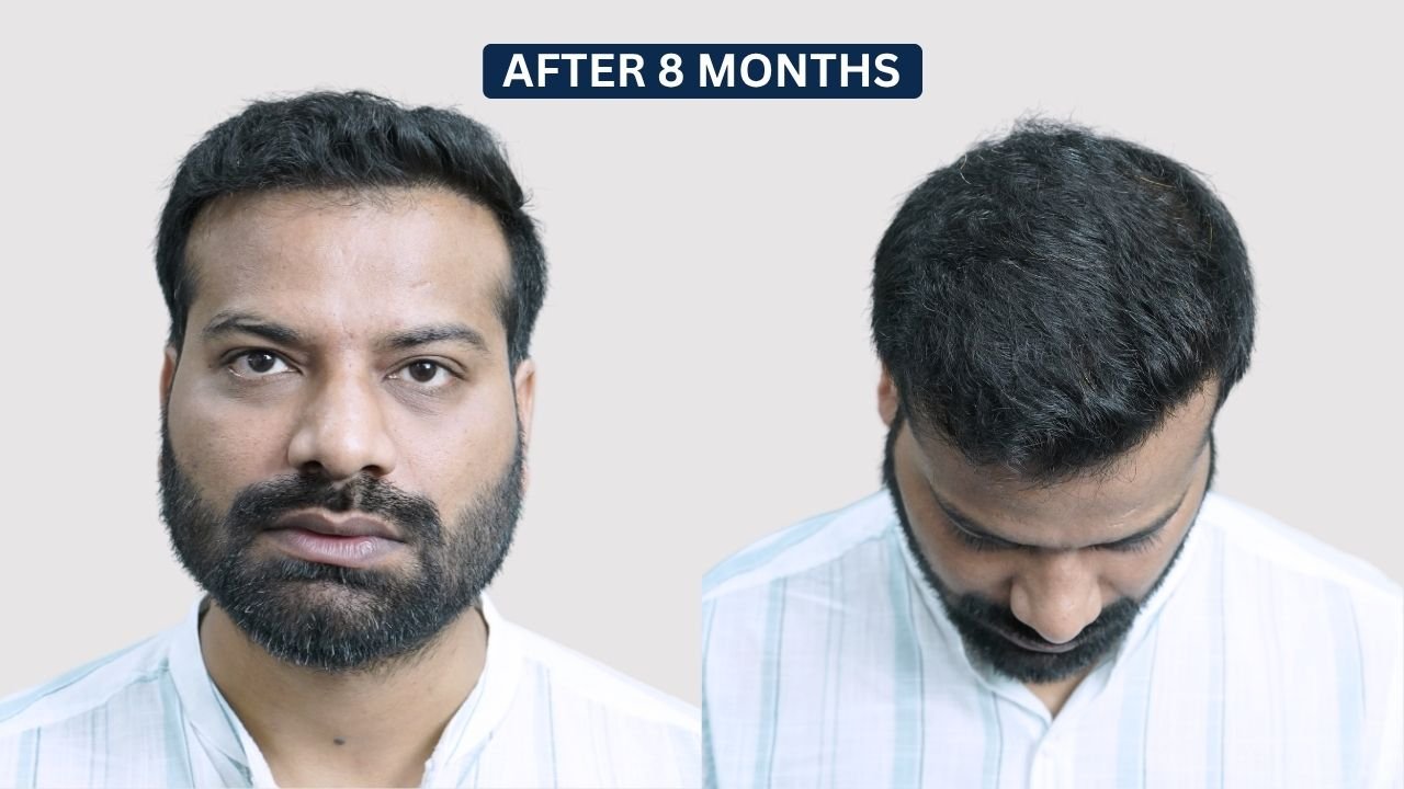 Hair Transplant in Pune Dr kiran chotaliya Hairfree and Hairgrow clinic