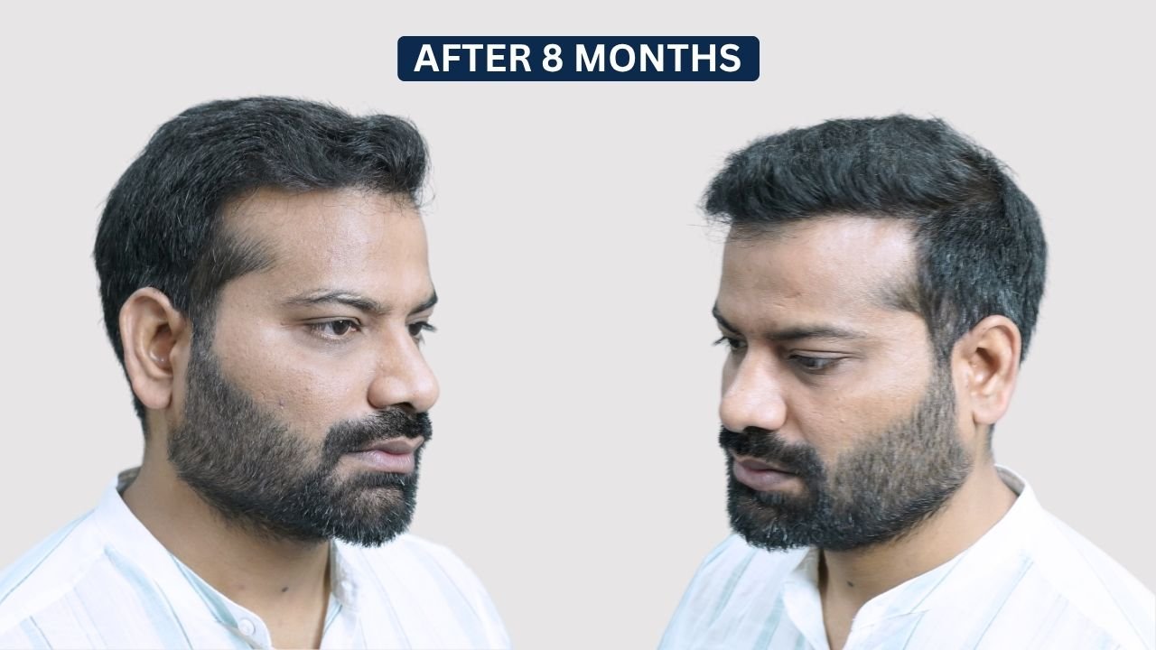 Hair Transplant in Pune Dr kiran chotaliya Hairfree and Hairgrow clinic