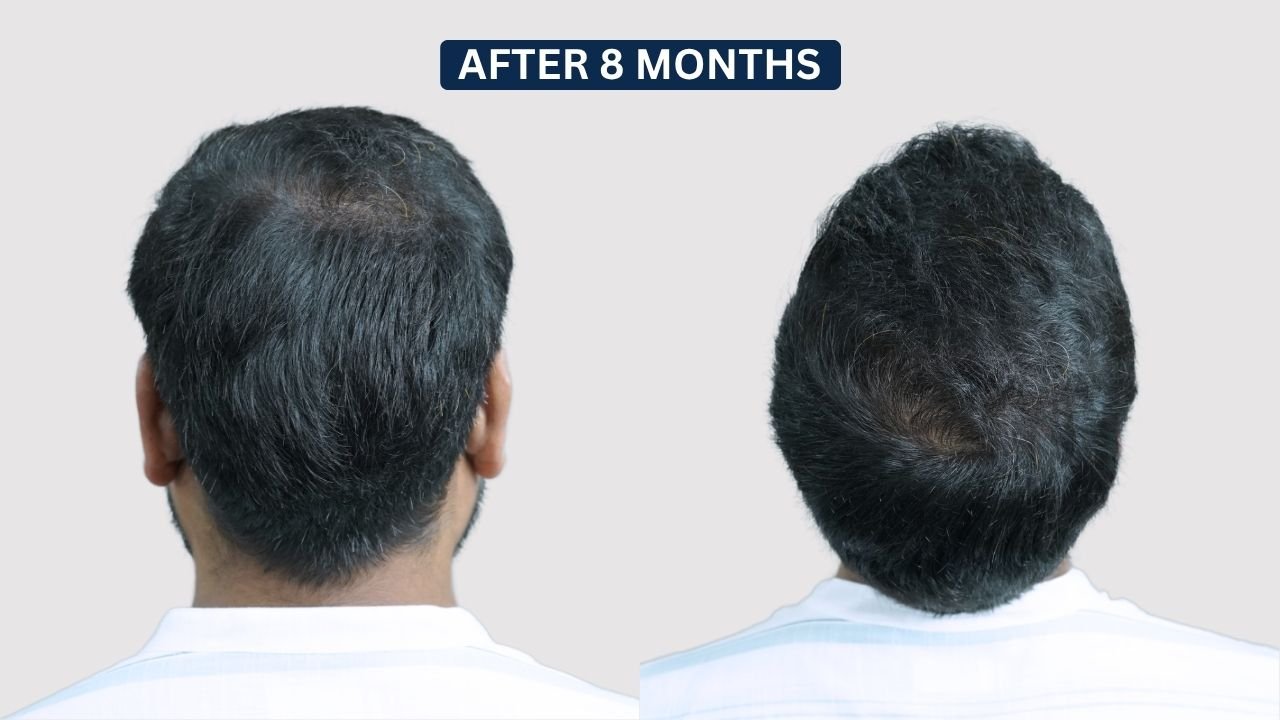 Hair Transplant in Pune Dr kiran chotaliya Hairfree and Hairgrow clinic