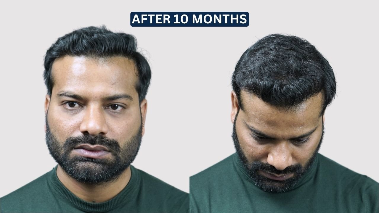 Hair Transplant in Pune Dr kiran chotaliya Hairfree and Hairgrow clinic