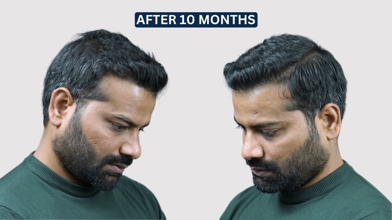 Hair Transplant in Pune Dr kiran chotaliya Hairfree and Hairgrow clinic