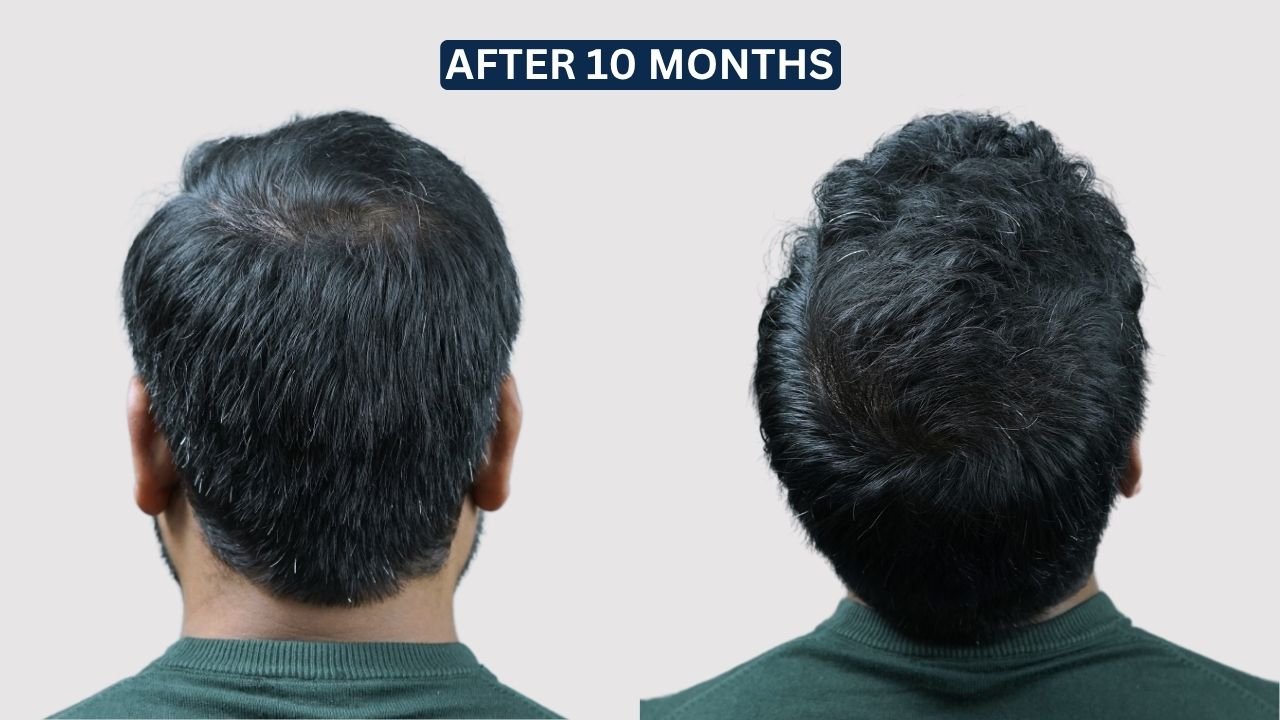 Hair Transplant in Pune Dr kiran chotaliya Hairfree and Hairgrow clinic