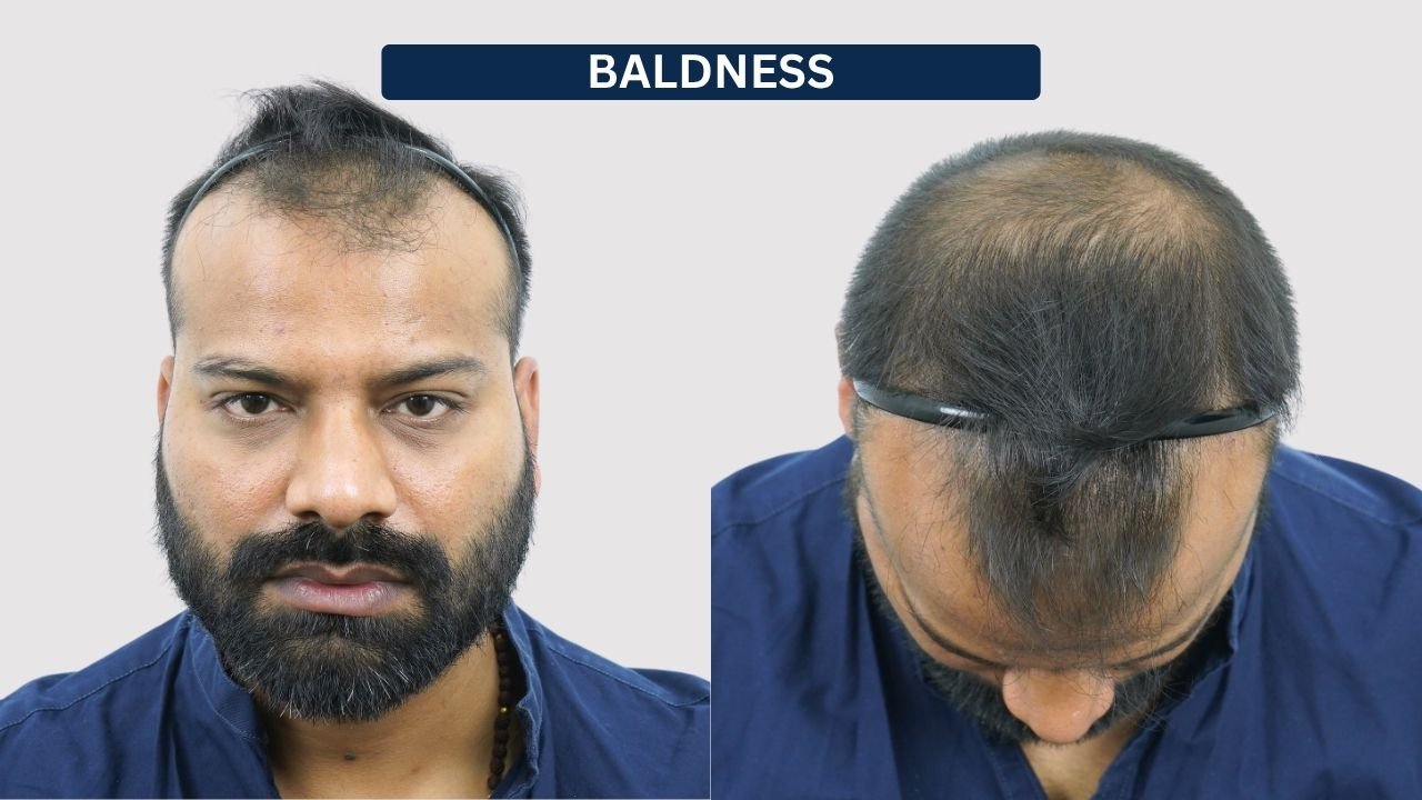 Hair Transplant in Pune Dr kiran chotaliya Hairfree and Hairgrow clinic