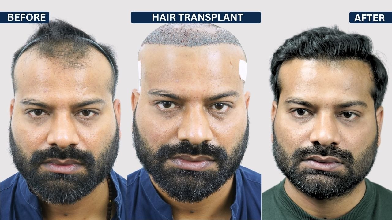 Hair Transplant in Pune Dr kiran chotaliya Hairfree and Hairgrow clinic
