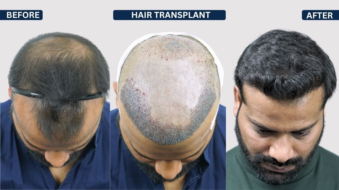 Hair Transplant in Pune Dr kiran chotaliya Hairfree and Hairgrow clinic