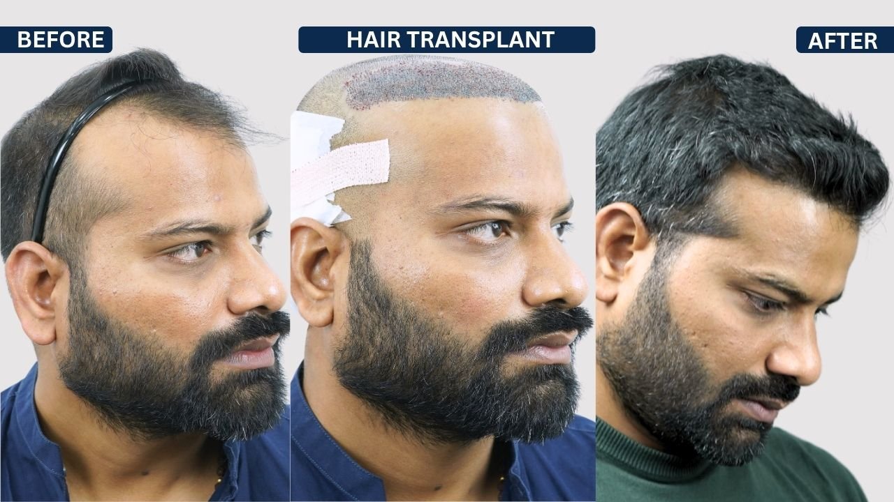 Hair Transplant in Pune Dr kiran chotaliya Hairfree and Hairgrow clinic