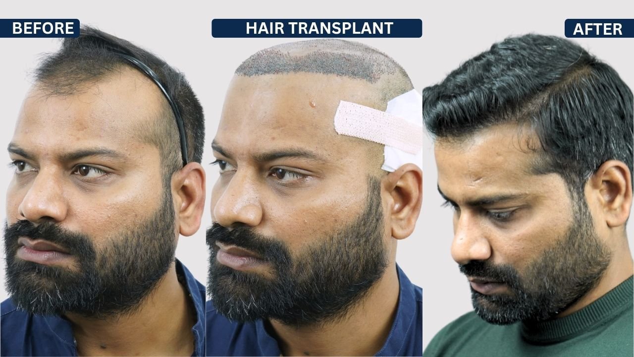 Hair Transplant in Pune Dr kiran chotaliya Hairfree and Hairgrow clinic