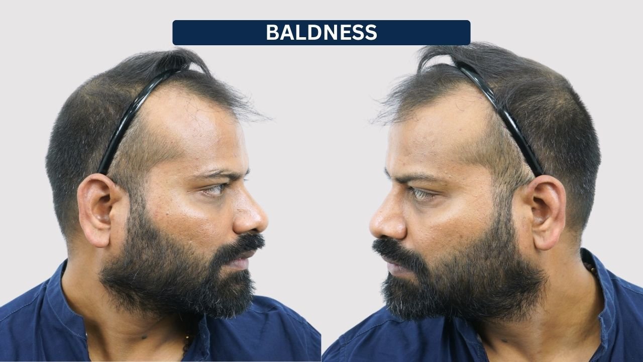 Hair Transplant in Pune Dr kiran chotaliya Hairfree and Hairgrow clinic