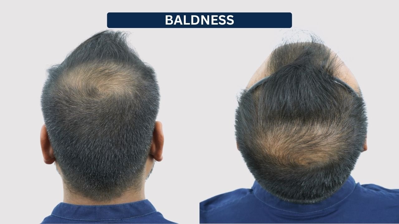 Hair Transplant in Pune Dr kiran chotaliya Hairfree and Hairgrow clinic