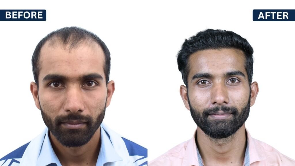 Hair Transplant in Pune Dr kiran chotaliya Hairfree and Hairgrow clinic