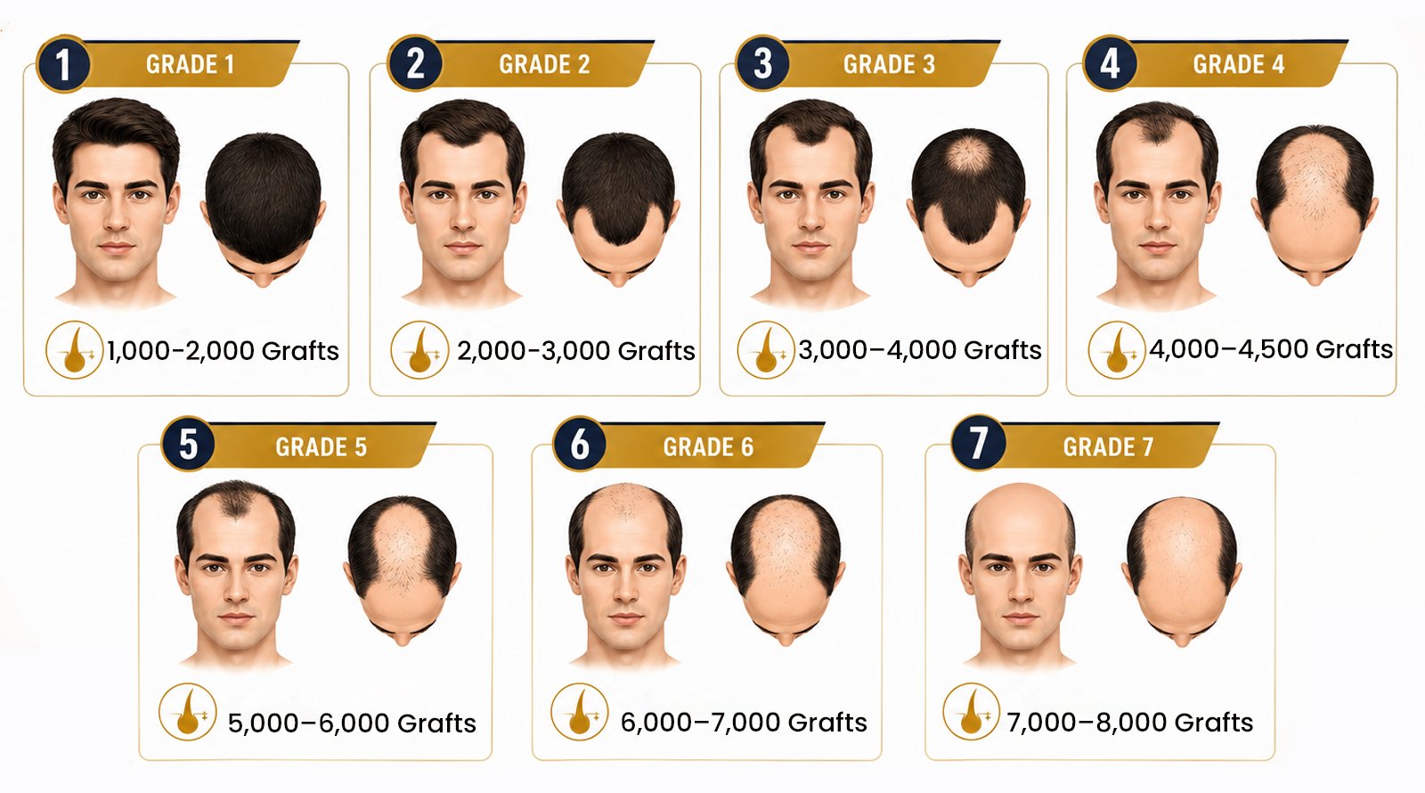 Norwood scale stages from grade 1 to 7 for male hair transplant candidates