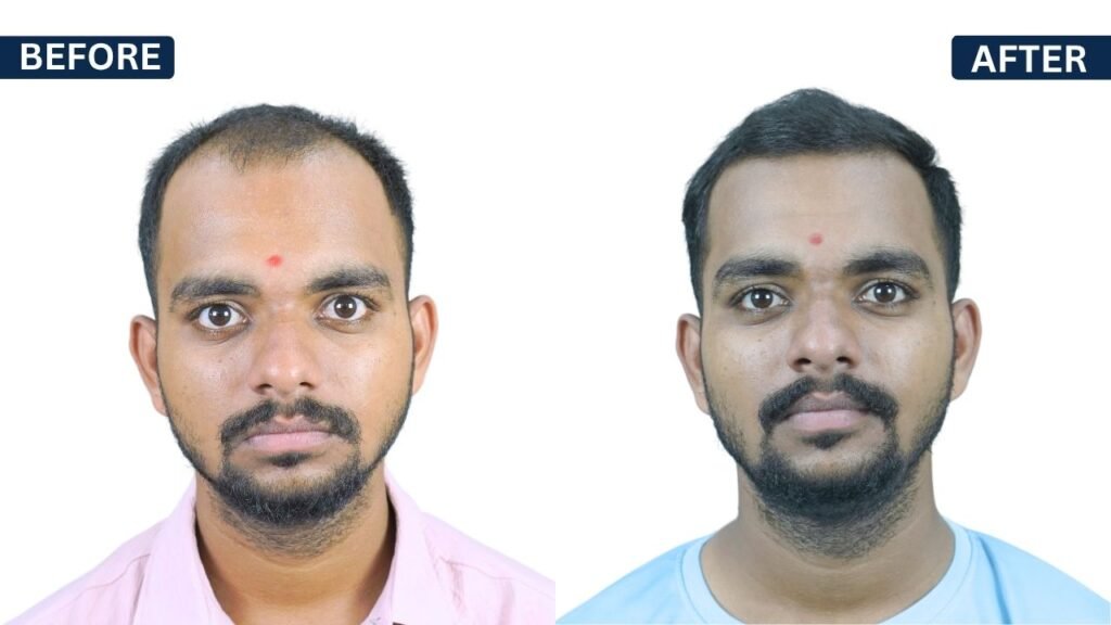 SANJAY SAPKAL PRP Treatment in Pune Hair Transplant in Pune, Dr Kiran Chotaliya