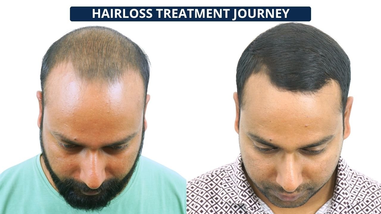 SHAHANWAJ ALAM PRP Treatment in Pune Hair Transplant in Pune, Dr Kiran Chotaliya