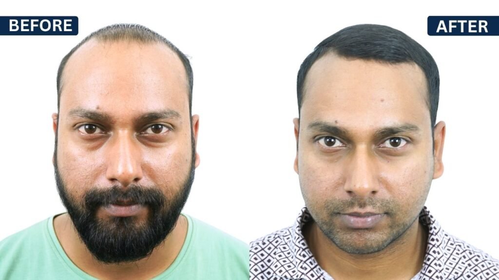 SHAHANWAJ ALAM PRP Treatment in Pune Hair Transplant in Pune, Dr Kiran Chotaliya